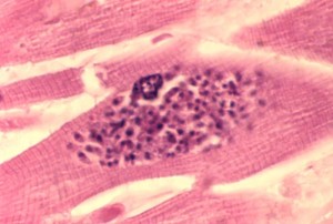 toxoplasmosis of the heart