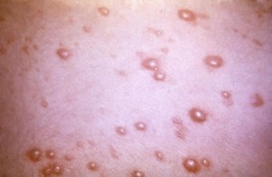 Chickenpox image/CDC