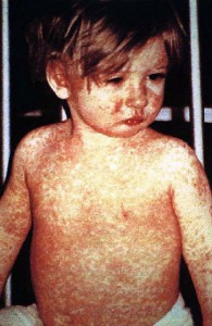 Measles   Image/CDC