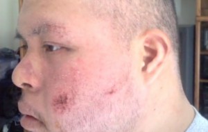 Antonio Martinez,  injured cheek close up photo 