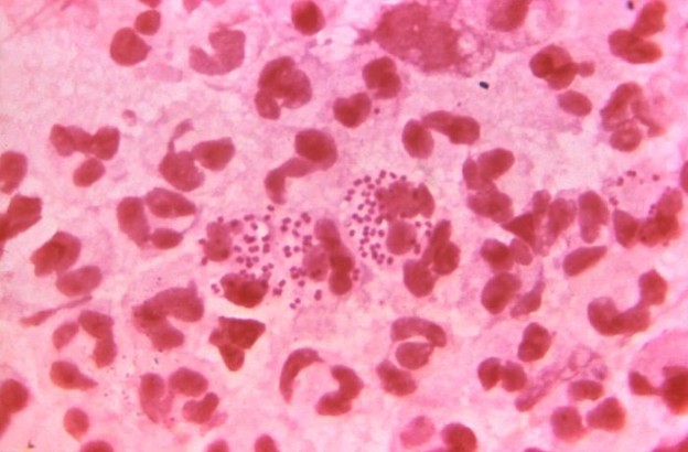 This Gram-stained photomicrograph reveals the presence of intracellular Gram-negative, Neisseria gonorrhoeae diplococcal bacteria, amongst numerous white blood cells (WBCs). Image/CDC