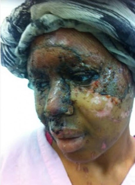 Naomi Oni after the acid attack, photo supplied