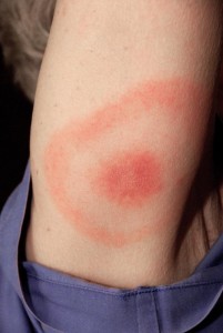 This 2007 photograph depicts the pathognomonic erythematous rash in the pattern of a “bull’s-eye”, which manifested at the site of a tick bite on this Maryland woman’s posterior right upper arm, who’d subsequently contracted Lyme disease. Image/CDC/ James Gathany