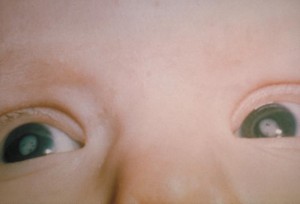 This photograph shows the cataracts in a child’s eyes due to Congenital Rubella Syndrome (CRS). Rubella is a viral disease that can affect susceptible persons of any age. Although generally a mild rash, if contracted in early pregnancy, there can be a high rate of fetal wastage or birth defects, known as Congenital Rubella Syndrome (CRS). Image/CDC