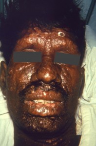 The face of this male patient exhibited some of the pathologic characteristic associated with a case of nodular lepromatous leprosy Image/CDC