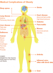 Medical complications of Obesity Image/CDC