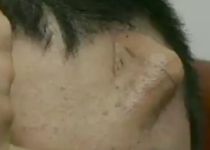 forehead nose Chinese man transplant