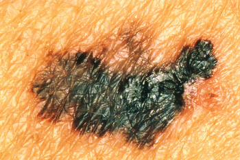 Melanoma with Color Differences Image/National Cancer Institute