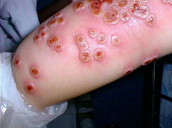 cowpox | disease | Britannica.com