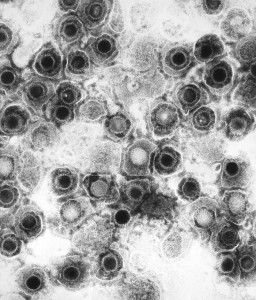 Herpes simplex virions  Image/CDC