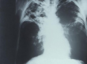 TB x-ray
