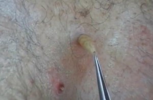 A botfly being extracted from a man's back.Image/YouTube Video Screen Shot