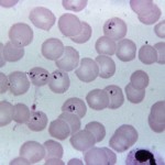 Malaria image/CDC