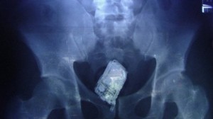 Phone-in-the-butt-xray