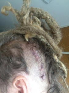 Frenzal Rhomb's Jay Whalley surgical scar Image/Frenzal Rhomb Facebook page
