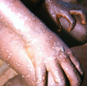 This 1967 photograph, which was captured in Accra, Ghana, depicts the hands, and knee region of both legs of a smallpox patient, displaying the characteristic maculopapular rash due to this viral disease. Image/CDC