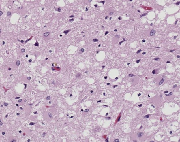 Magnified 100X, and stained with H&E (hematoxylin and eosin) staining technique, this light photomicrograph of brain tissue reveals the presence of prominent spongiotic changes in the cortex, and loss of neurons in a case of variant Creutzfeldt-Jakob disease (vCJD). Image/CDC