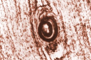 Trichinella spiralis cyst Image/CDC