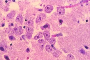 Balamuthia mandrillaris infecting brain tissue Image/CDC