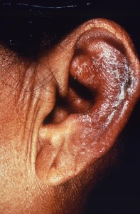 Leprosy Image/CDC