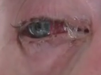 Bad case of pink eye Image/Video Screen Shot