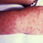 Characteristic spotted rash of Rocky Mountain spotted fever/CDC
