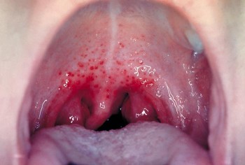 Strep throat/CDC