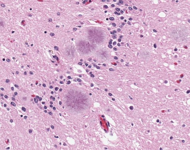 Variant Creutzfeldt-Jakob disease (vCJD)- photomicrograph of brain tissue reveals the presence of typical amyloid plaques/CDC