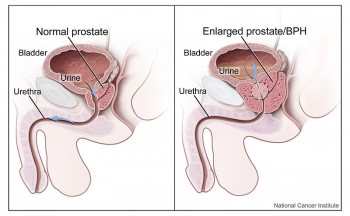 Prostate (normal and enlarged) Image in the public domain by Alan Hoofring