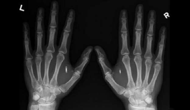 microchip-in-hands-xray