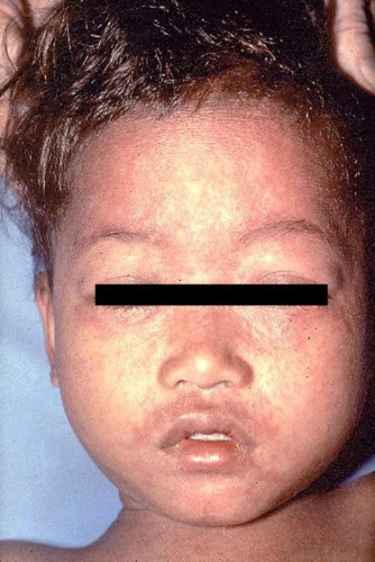 Measles in child/CDC