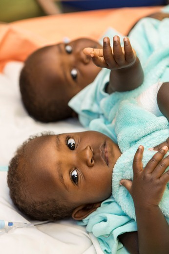 Acen (bottom) and Apio (top) Akello the morning before their separation surgery at Nationwide Children`s Hospital on Sept. 3, 2015. Image/Nationwide Children’s Hospital.